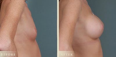Breast Augmentation Before & After Gallery - Patient 169398 - Image 3