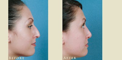 Aesthetic Rhinoplasty Before & After Gallery - Patient 358351 - Image 3