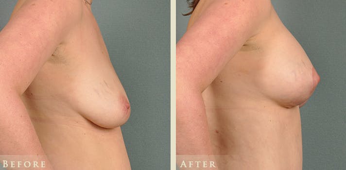 Breast Augmentation and Lift Before & After Gallery - Patient 203292 - Image 2