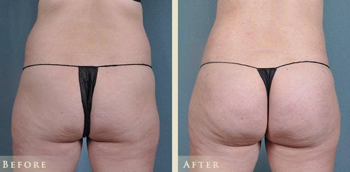 Brazilian Butt Lift Before & After Gallery - Patient 356715 - Image 1