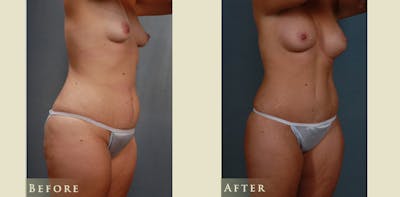 Mommy Makeover Before & After Gallery - Patient 528835 - Image 2