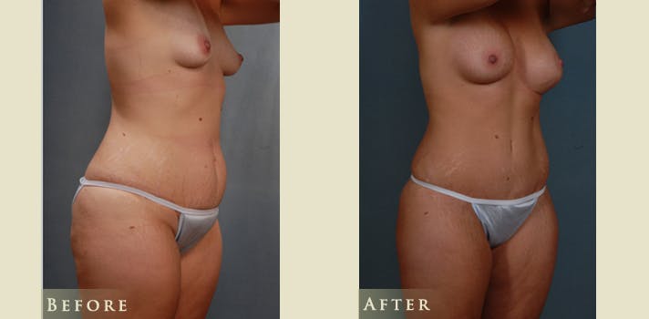 Mommy Makeover Before & After Gallery - Patient 528835 - Image 2