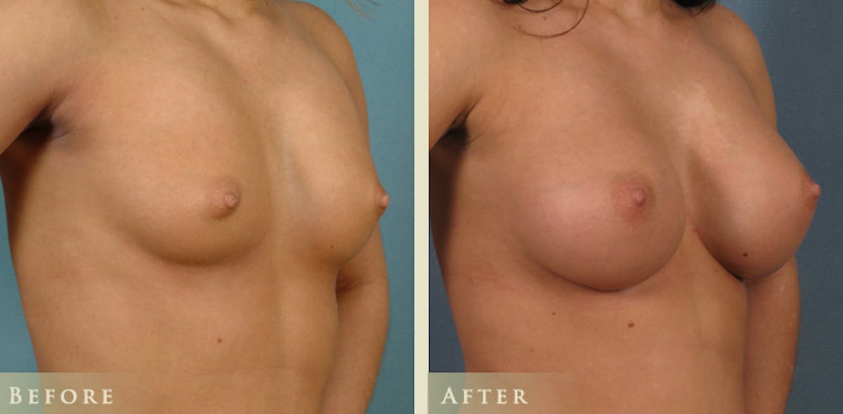 Breast Augmentation with Saline Implants Before & After Gallery - Patient 242784 - Image 2