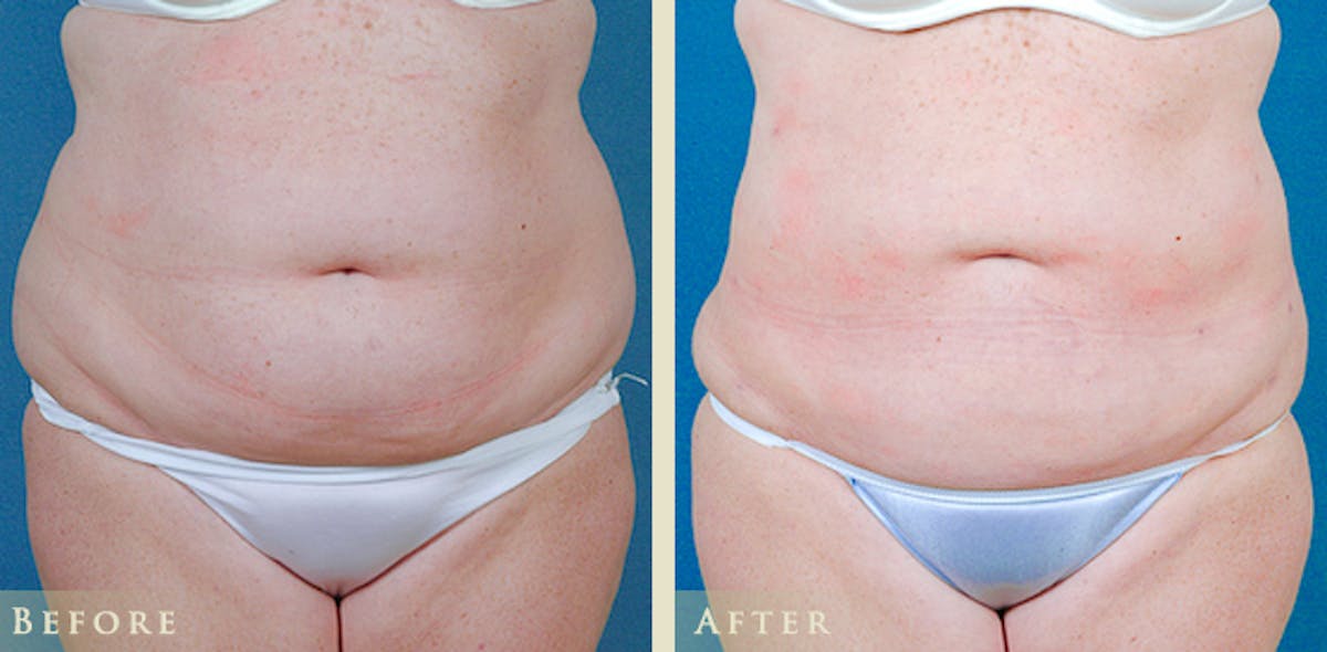 Female Liposuction Before & After Gallery - Patient 411662 - Image 1