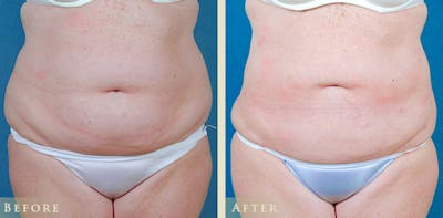 Female Liposuction Before & After Gallery - Patient 411662 - Image 1