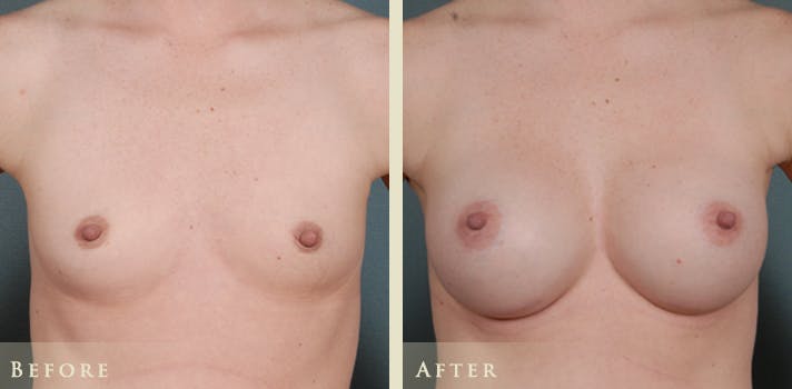 Breast Augmentation Before & After Gallery - Patient 432158 - Image 1