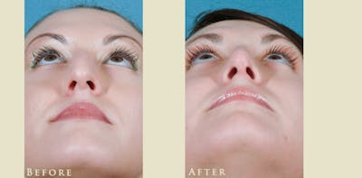 Aesthetic Rhinoplasty Before & After Gallery - Patient 358351 - Image 4