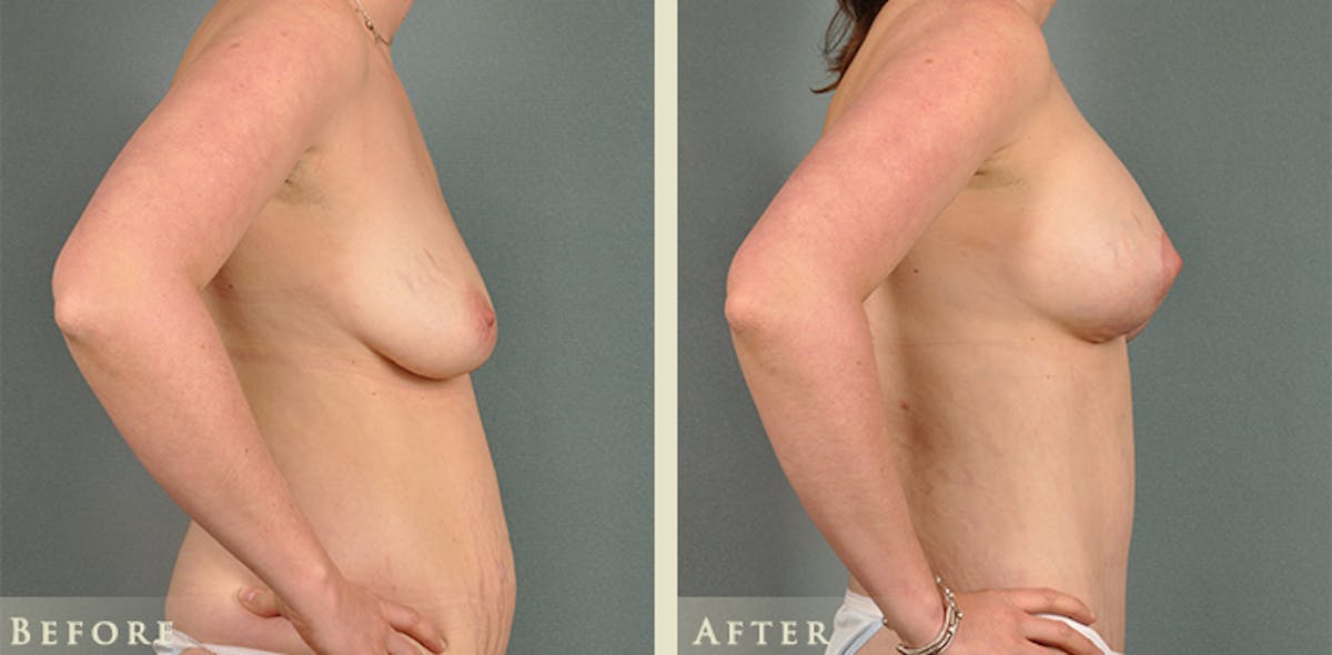 Breast Augmentation and Lift  Before & After Gallery - Patient 203292 - Image 4