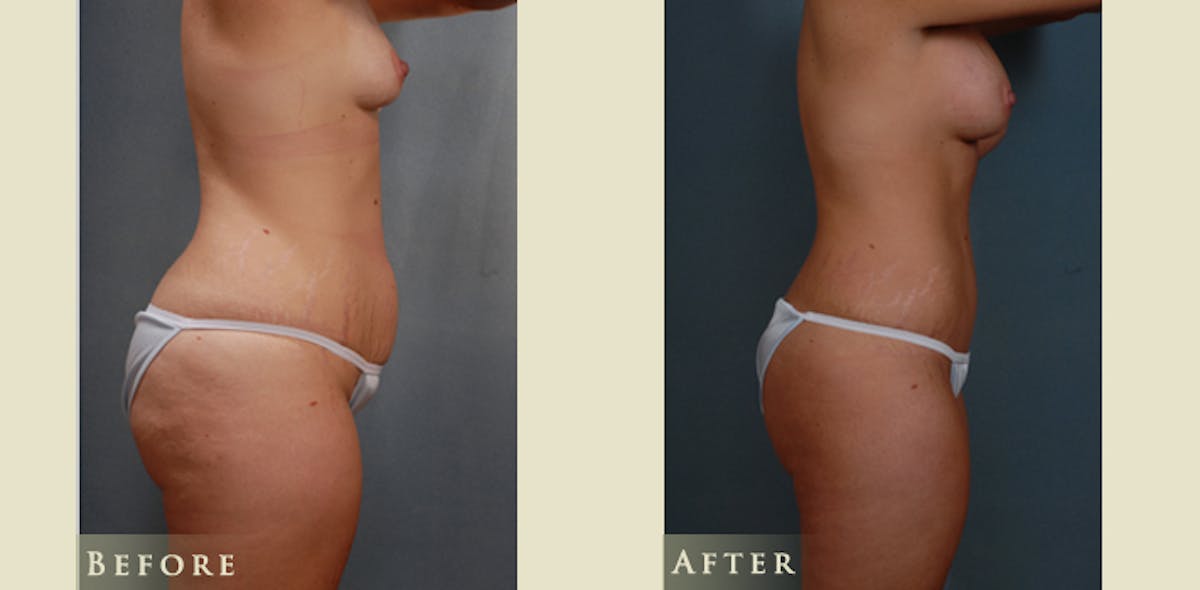 Mommy Makeover Before & After Gallery - Patient 528835 - Image 3