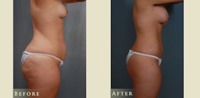 Mommy Makeover Before & After Gallery - Patient 528835 - Image 3