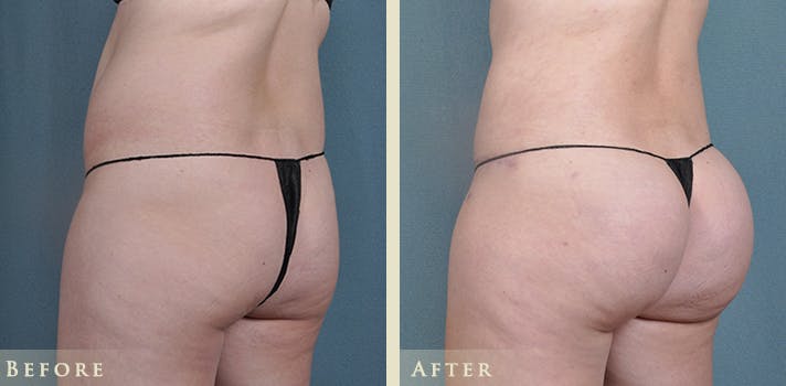 Brazilian Butt Lift Before & After Gallery - Patient 356715 - Image 2