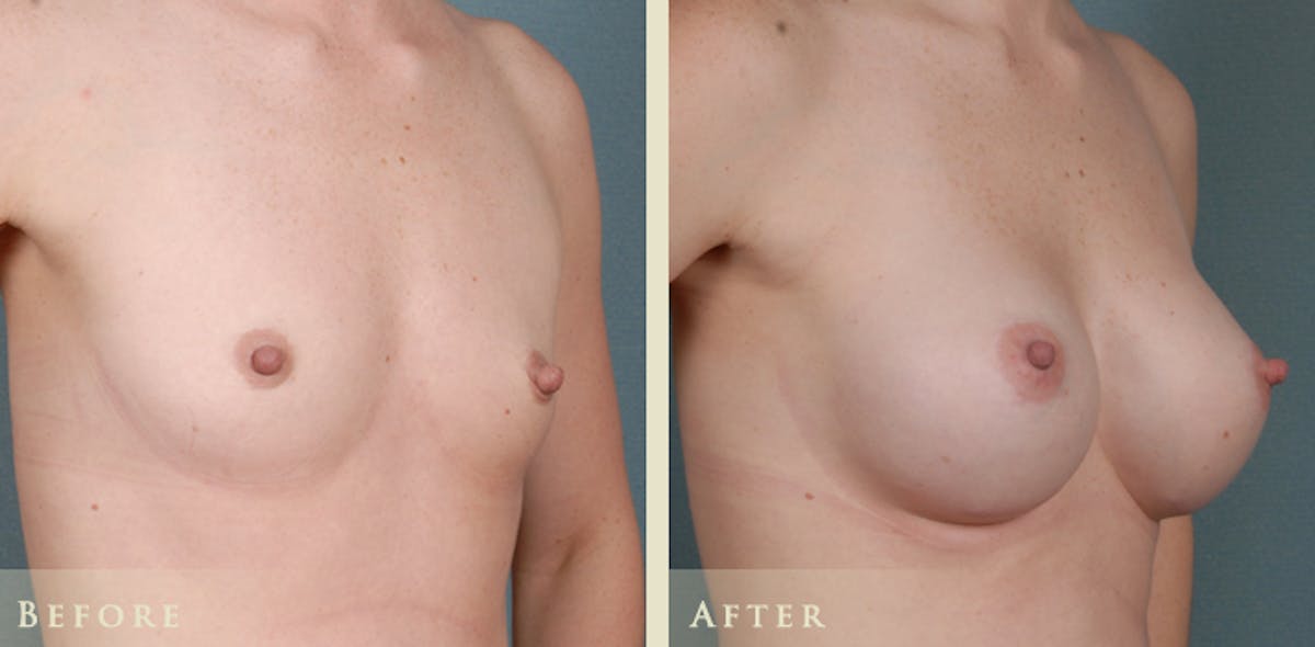 Breast Augmentation with Silicone Implants Before & After Gallery - Patient 432158 - Image 2