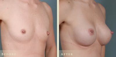 Breast Augmentation Before & After Gallery - Patient 432158 - Image 2