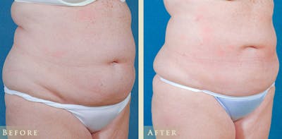 Female Liposuction Before & After Gallery - Patient 411662 - Image 2