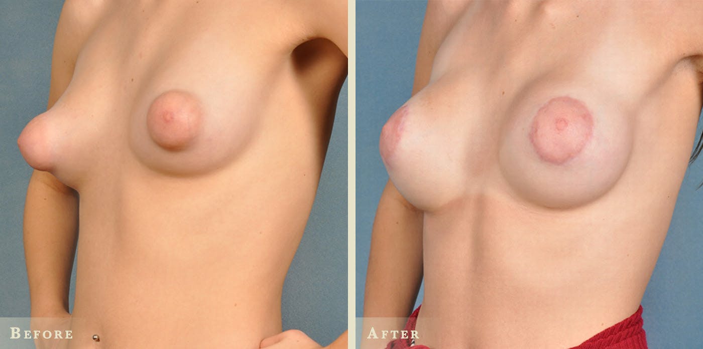 Breast Augmentation Before & After Gallery - Patient 381410 - Image 1