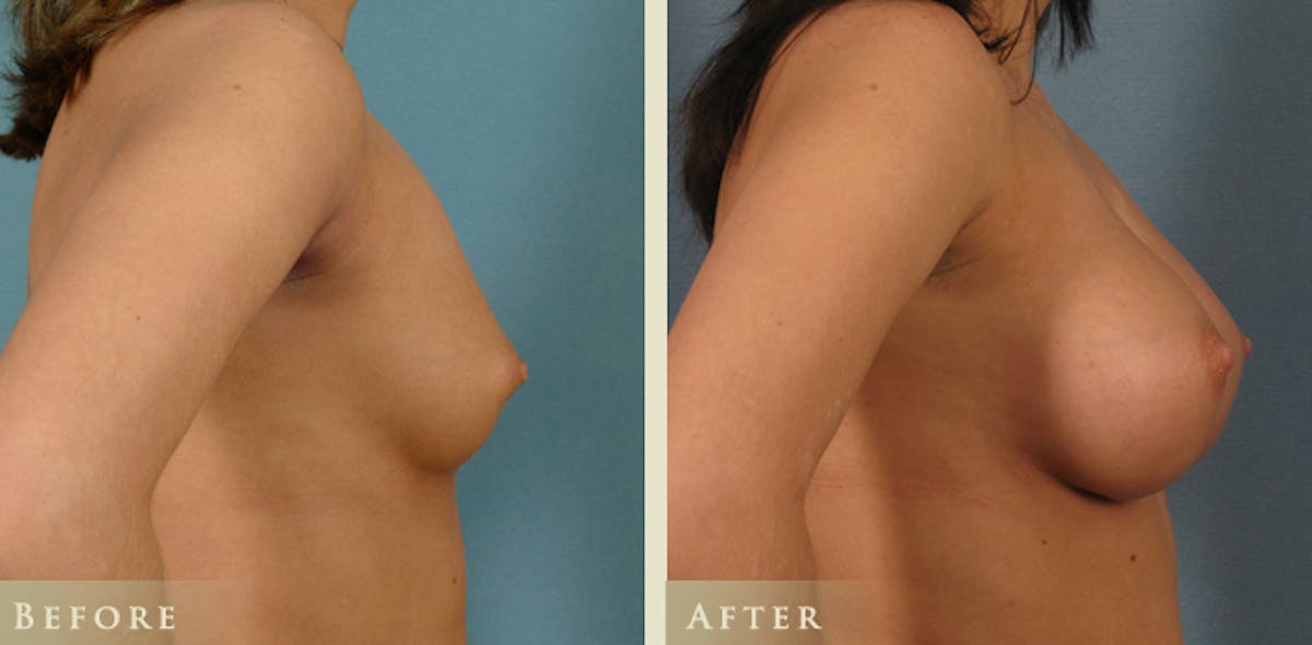 Breast Augmentation with Saline Implants Before & After Gallery - Patient 242784 - Image 3