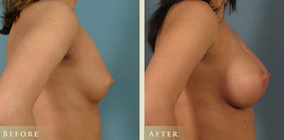 Breast Augmentation Before & After Gallery - Patient 108090 - Image 3