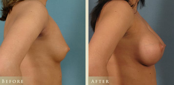 Breast Augmentation Before & After Gallery - Patient 108090 - Image 3