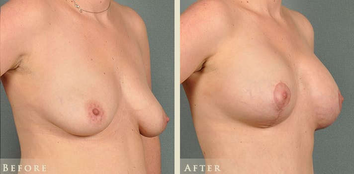 Breast Augmentation and Lift Before & After Gallery - Patient 203292 - Image 3