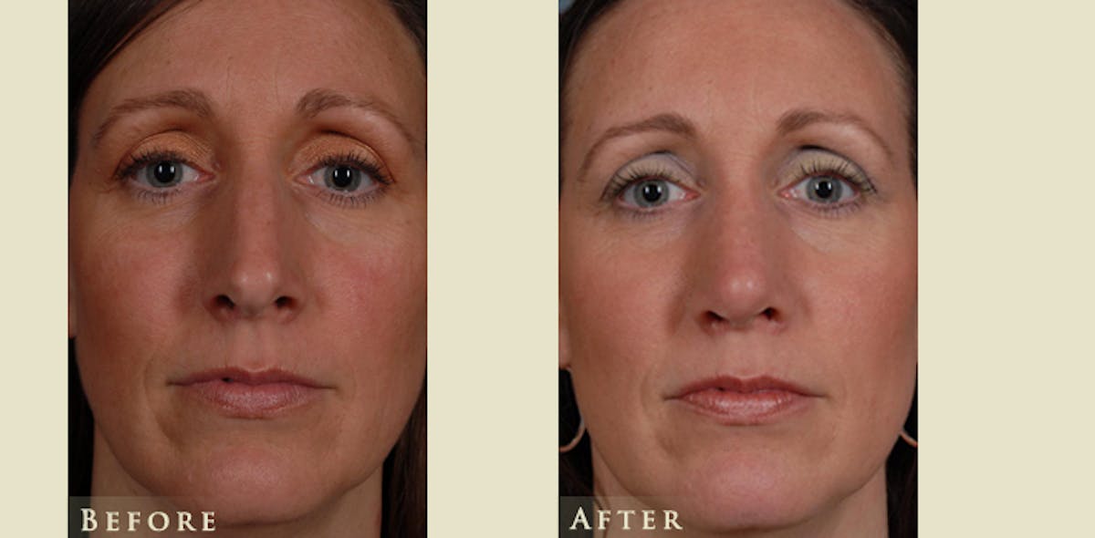 Aesthetic Rhinoplasty Before & After Gallery - Patient 754906 - Image 1