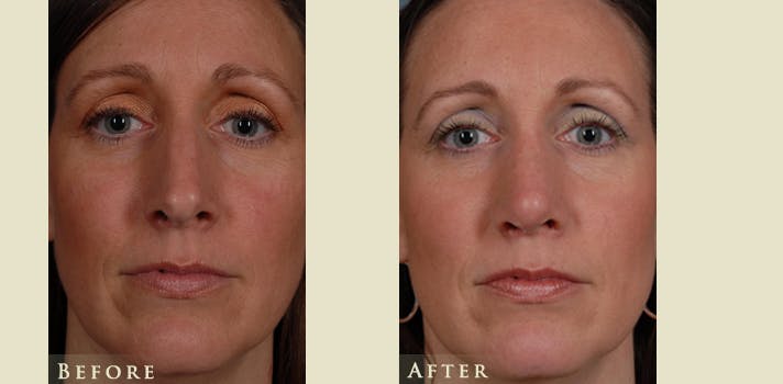 Aesthetic Rhinoplasty Before & After Gallery - Patient 754906 - Image 1