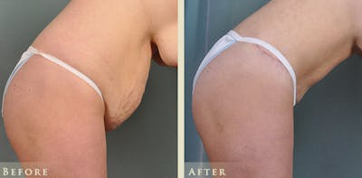 Tummy Tuck Before & After Gallery - Patient 247890 - Image 7