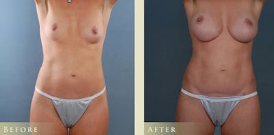 Mommy Makeover Before & After Gallery - Patient 390486 - Image 1