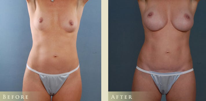 Mommy Makeover Before & After Gallery - Patient 390486 - Image 1
