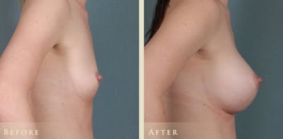 Breast Augmentation Before & After Gallery - Patient 432158 - Image 3