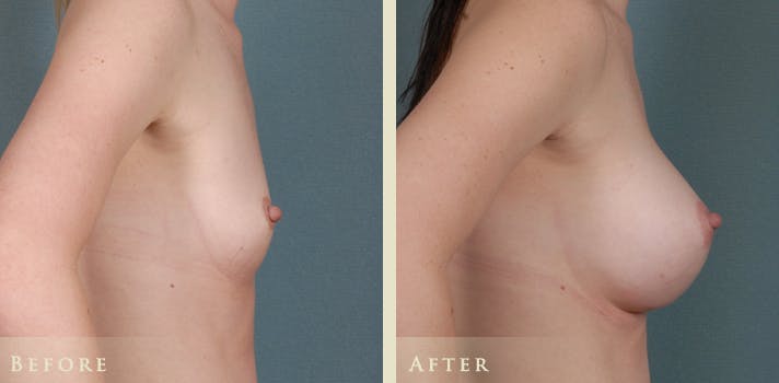 Breast Augmentation Before & After Gallery - Patient 432158 - Image 3