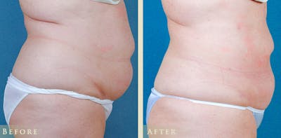 Female Liposuction Before & After Gallery - Patient 411662 - Image 3