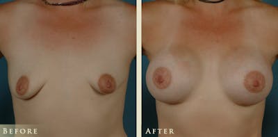Breast Augmentation Before & After Gallery - Patient 306920 - Image 1