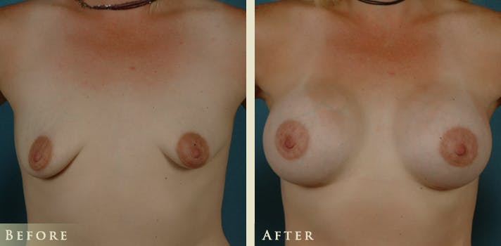 Breast Augmentation Before & After Gallery - Patient 306920 - Image 1