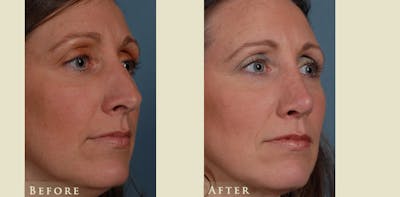 Aesthetic Rhinoplasty Before & After Gallery - Patient 754906 - Image 2