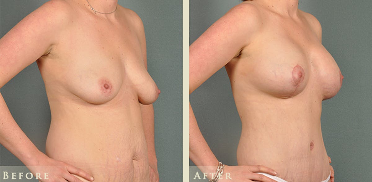 Breast Augmentation and Lift  Before & After Gallery - Patient 203292 - Image 6