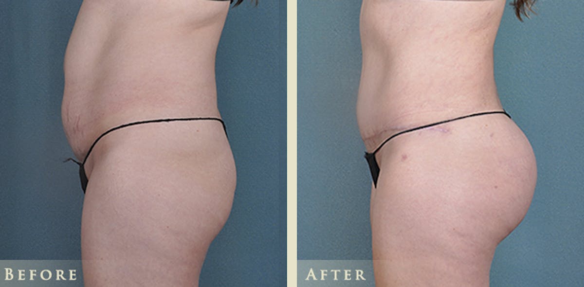 Brazilian Butt Lift Before & After Gallery - Patient 356715 - Image 4