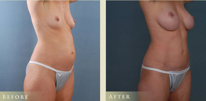 Mommy Makeover Before & After Gallery - Patient 390486 - Image 2