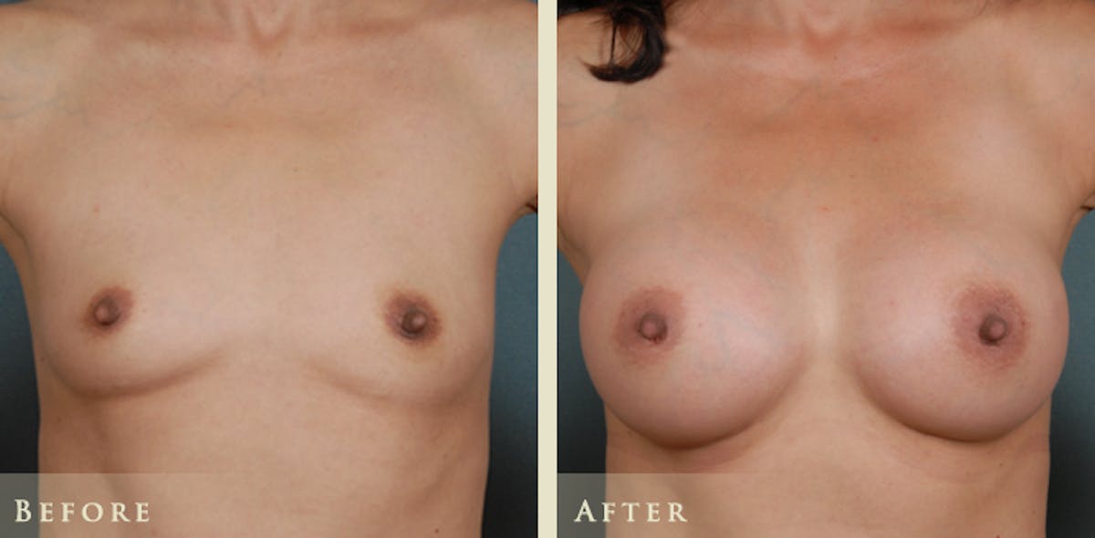 Breast Augmentation with Silicone Implants Before & After Gallery - Patient 158092 - Image 1