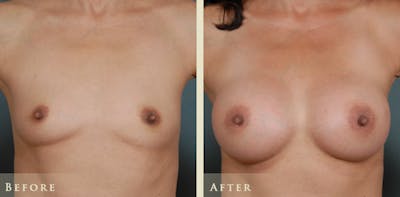 Breast Augmentation Before & After Gallery - Patient 158092 - Image 1