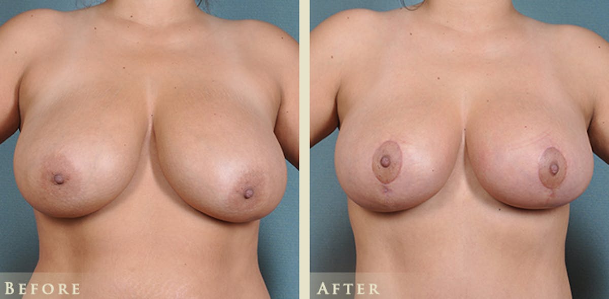 Breast Reduction Before & After Gallery - Patient 398898 - Image 1