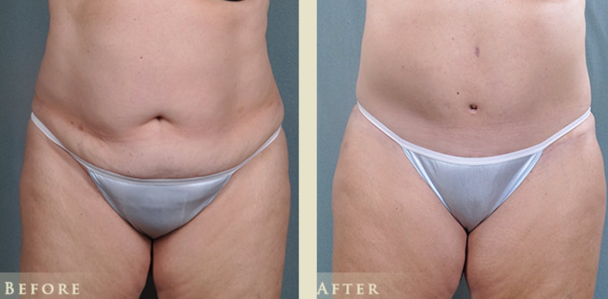 Tummy Tuck Before & After Gallery - Patient 257737 - Image 1