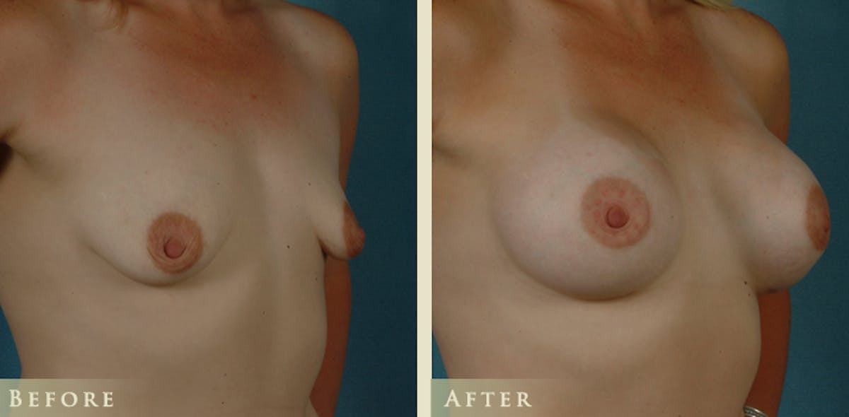 Breast Augmentation with Saline Implants Before & After Gallery - Patient 374024 - Image 2