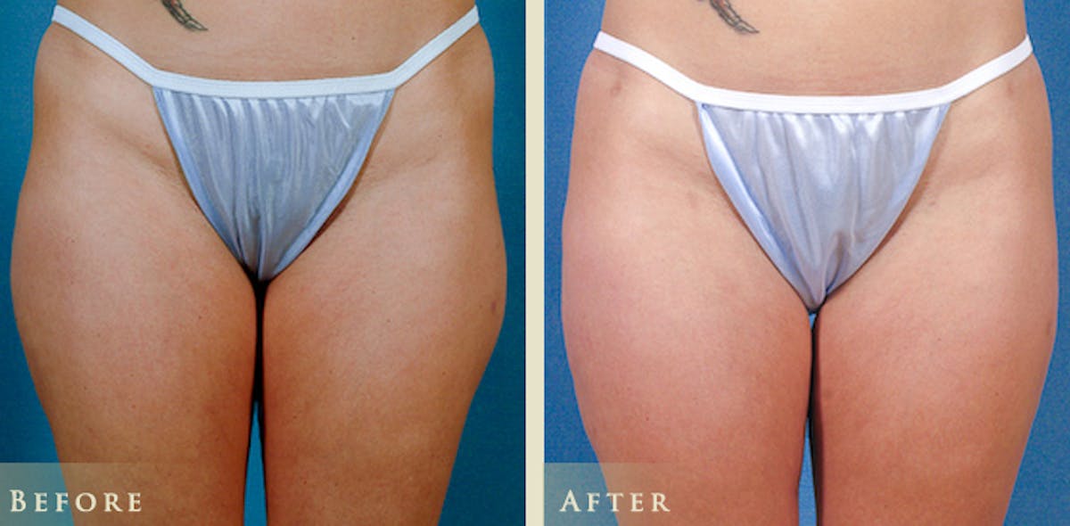 Female Liposuction Before & After Gallery - Patient 279287 - Image 1