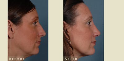 Aesthetic Rhinoplasty Before & After Gallery - Patient 754906 - Image 3