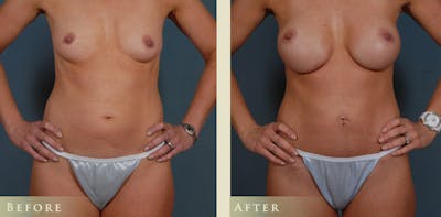 Mommy Makeover Before & After Gallery - Patient 390486 - Image 3