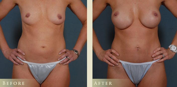 Mommy Makeover Before & After Gallery - Patient 390486 - Image 3