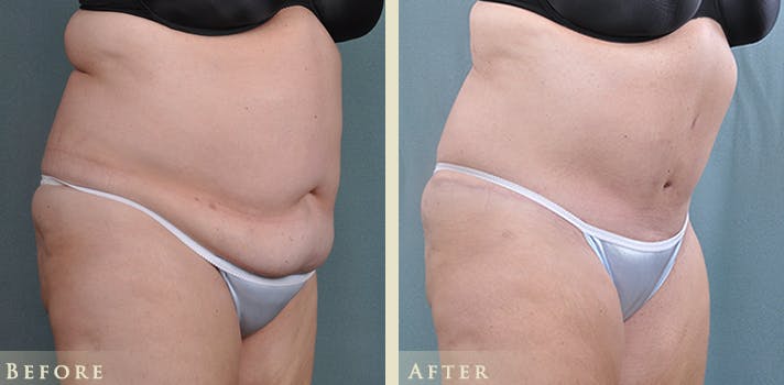 Tummy Tuck Before & After Gallery - Patient 257737 - Image 2