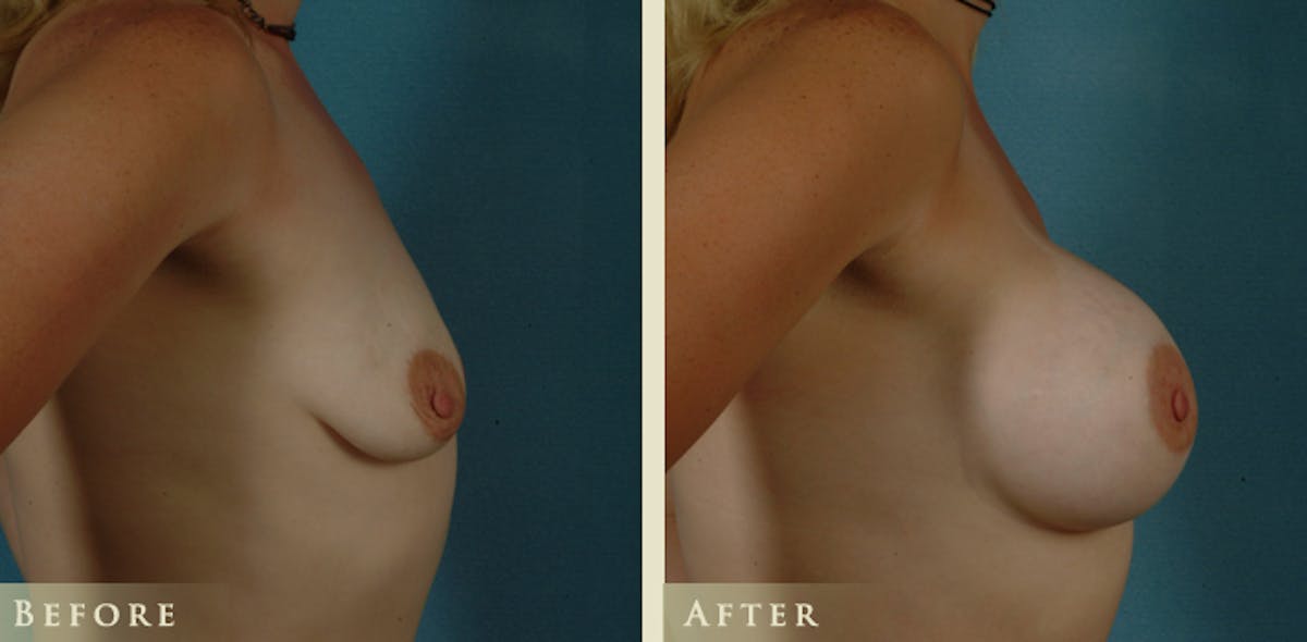 Breast Augmentation with Saline Implants Before & After Gallery - Patient 374024 - Image 3