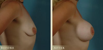 Breast Augmentation Before & After Gallery - Patient 306920 - Image 3