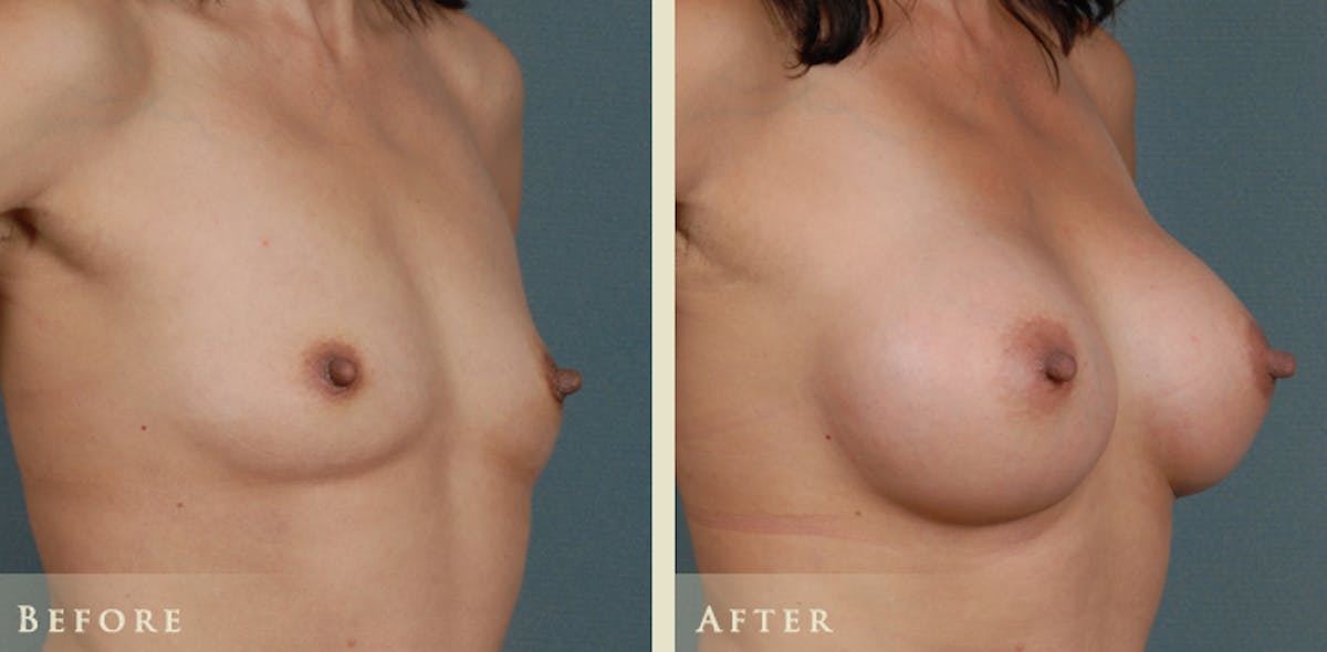Breast Augmentation with Silicone Implants Before & After Gallery - Patient 158092 - Image 2